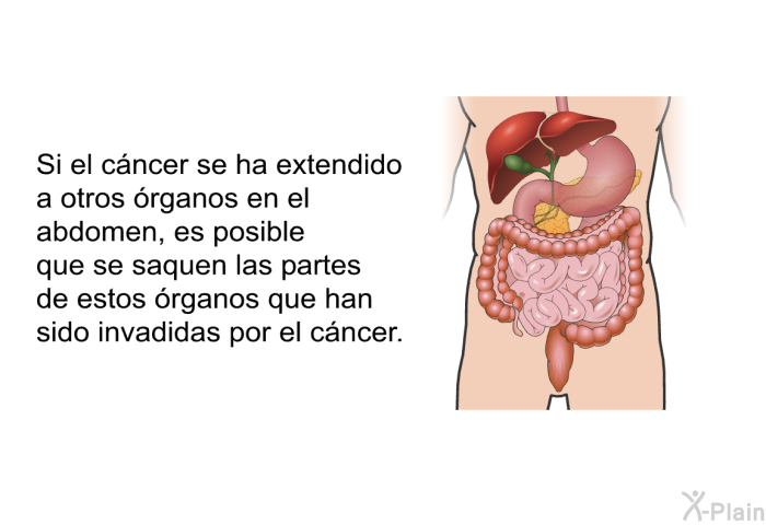 Si el cncer se ha extendido a otros rganos en el abdomen, es posible que se saquen las partes de estos rganos que han sido invadidas por el cncer.