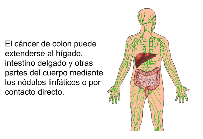 El cncer de colon puede extenderse al hgado, intestino delgado y otras partes del cuerpo mediante los ndulos linfticos o por contacto directo.