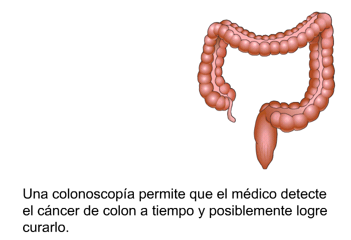 Una colonoscopa permite que el mdico detecte el cncer de colon a tiempo y posiblemente logre curarlo.