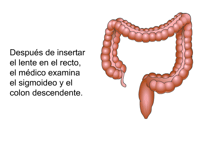 Despus de insertar el lente en el recto, el mdico examina el sigmoideo y el colon descendente.
