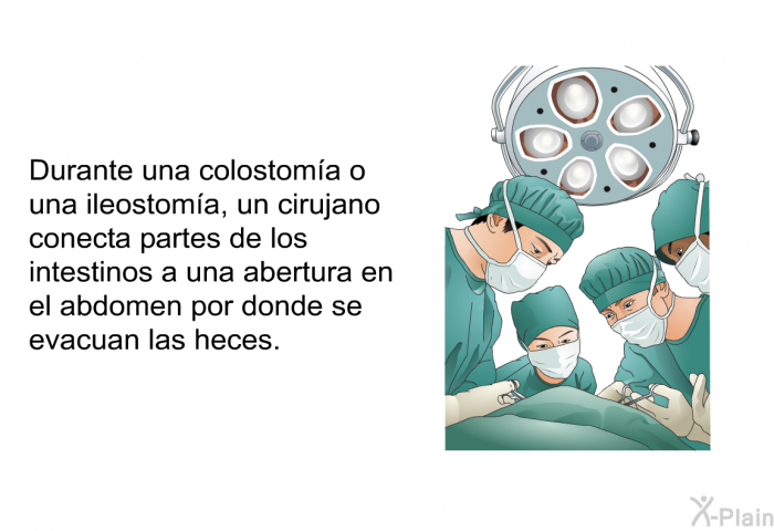 Durante una colostoma o una ileostoma, un cirujano conecta partes de los intestinos a una abertura en el abdomen por donde se evacuan las heces.