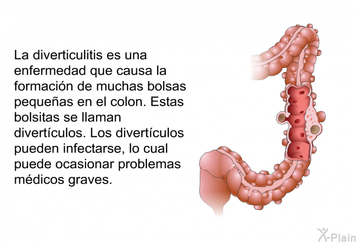 La diverticulitis es una enfermedad que causa la formacin de muchas bolsas pequeas en el colon. Estas bolsitas se llaman divertculos. Los divertculos pueden infectarse, lo cual puede ocasionar problemas mdicos graves.