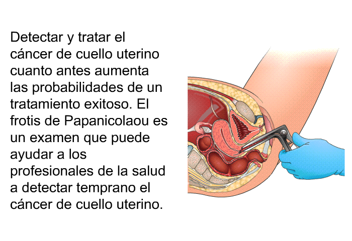 Detectar y tratar el cncer de cuello uterino cuanto antes aumenta las probabilidades de un tratamiento exitoso. El frotis de Papanicolaou es un examen que puede ayudar a los profesionales de la salud a detectar temprano el cncer de cuello uterino.