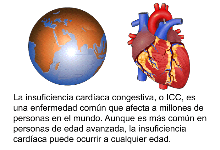 La insuficiencia cardaca congestiva, o ICC, es una enfermedad comn que afecta a millones de personas en el mundo. Aunque es ms comn en personas de edad avanzada, la insuficiencia cardaca puede ocurrir a cualquier edad.