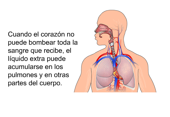 Cuando el corazn no puede bombear toda la sangre que recibe, el lquido extra puede acumularse en los pulmones y en otras partes del cuerpo.