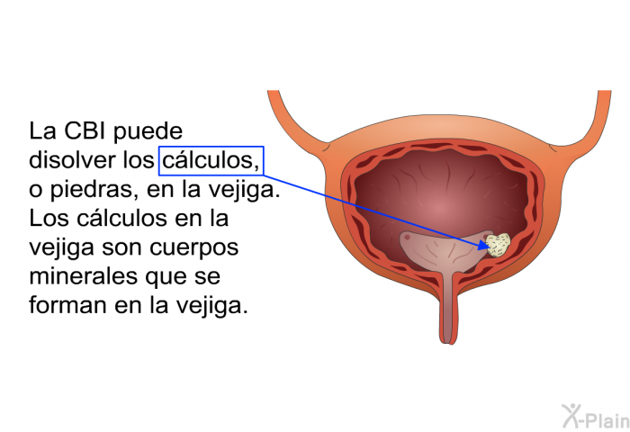 La CBI puede disolver los clculos, o piedras, en la vejiga. Los clculos en la vejiga son cuerpos minerales que se forman en la vejiga.