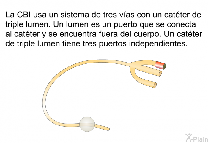 La CBI usa un sistema de tres vas con un catter de triple lumen. Un lumen es un puerto que se conecta al catter y se encuentra fuera del cuerpo. Un catter de triple lumen tiene tres puertos independientes.