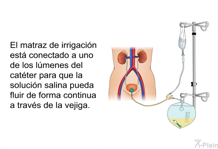 El matraz de irrigacin est conectado a uno de los lmenes del catter para que la solucin salina pueda fluir de forma continua a travs de la vejiga.