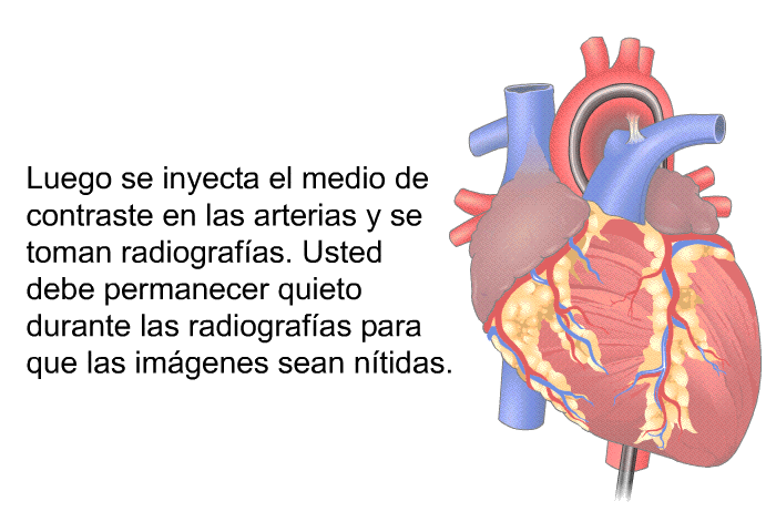 Luego se inyecta el medio de contraste en las arterias y se toman radiografas. Usted debe permanecer quieto durante las radiografas para que las imgenes sean ntidas.