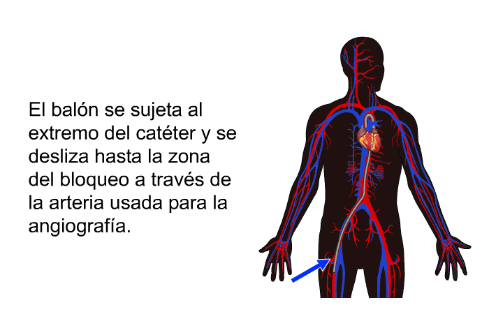 El baln se sujeta al extremo del catter y se desliza hasta la zona del bloqueo a travs de la arteria usada para la angiografa.
