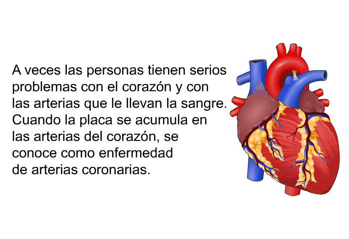 A veces las personas tienen serios problemas con el corazn y con las arterias que le llevan la sangre. Cuando la placa se acumula en las arterias del corazn, se conoce como enfermedad de arterias coronarias.