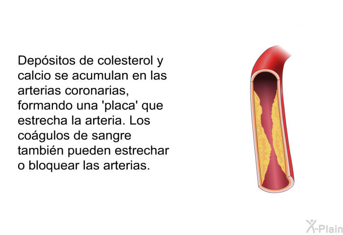Depsitos de colesterol y calcio se acumulan en las arterias coronarias, formando una 'placa' que estrecha la arteria. Los cogulos de sangre tambin pueden estrechar o bloquear las arterias.