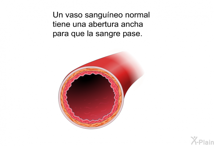 Un vaso sanguneo normal tiene una abertura ancha para que la sangre pase.