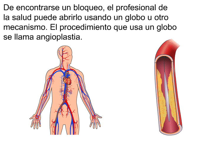 De encontrarse un bloqueo, el profesional de la salud puede abrirlo usando un globo u otro mecanismo. El procedimiento que usa un globo se llama angioplastia.