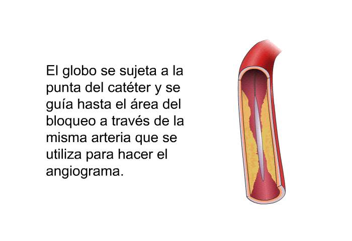 El globo se sujeta a la punta del cat�ter y se gu�a hasta el �rea del bloqueo a trav�s de la misma arteria que se utiliza para hacer el angiograma.