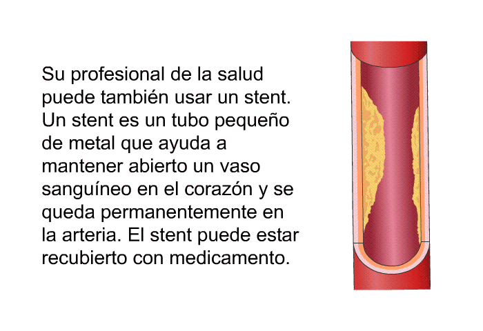 Su profesional de la salud puede tambi�n usar un stent. Un stent es un tubo peque�o de metal que ayuda a mantener abierto un vaso sangu�neo en el coraz�n y se queda permanentemente en la arteria. El stent puede estar recubierto con medicamento.