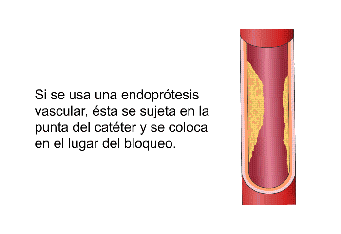 Si se usa una endopr�tesis vascular, �sta se sujeta en la punta del cat�ter y se coloca en el lugar del bloqueo.