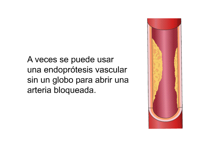 A veces se puede usar una endopr�tesis vascular sin un globo para abrir una arteria bloqueada.
