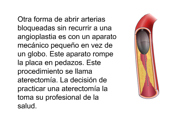 Otra forma de abrir arterias bloqueadas sin recurrir a una angioplastia es con un aparato mec�nico peque�o en vez de un globo. Este aparato rompe la placa en pedazos. Este procedimiento se llama aterectom�a. La decisi�n de practicar una aterectom�a la toma su profesional de la salud.