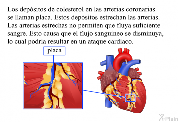 Los depsitos de colesterol en las arterias coronarias se llaman placa. Estos depsitos estrechan las arterias. Las arterias estrechas no permiten que fluya suficiente sangre. Esto causa que el flujo sanguneo se disminuya, lo cual podra resultar en un ataque cardaco.