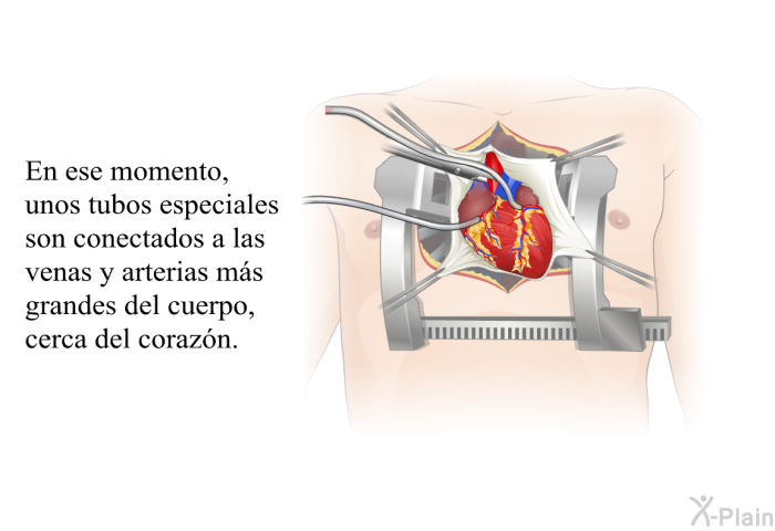 En ese momento, unos tubos especiales son conectados a las venas y arterias ms grandes del cuerpo, cerca del corazn.