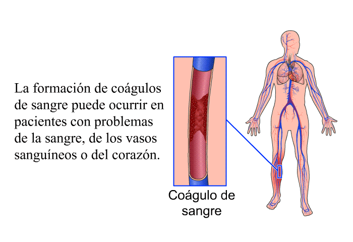 La formacin de cogulos de sangre puede ocurrir en pacientes con problemas de la sangre, de los vasos sanguneos o del corazn.