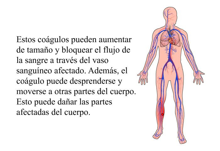 Estos cogulos pueden aumentar de tamao y bloquear el flujo de la sangre a travs del vaso sanguneo afectado. Adems, el cogulo puede desprenderse y moverse a otras partes del cuerpo. Esto puede daar las partes afectadas del cuerpo.