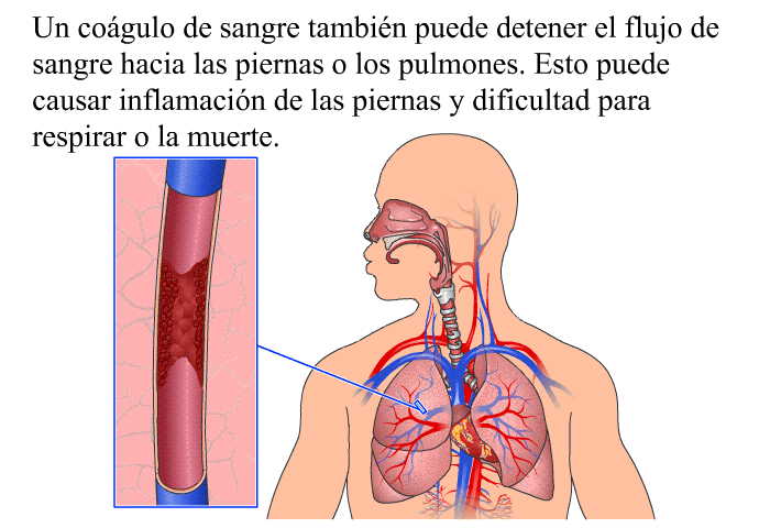 Un cogulo de sangre tambin puede detener el flujo de sangre hacia las piernas o los pulmones. Esto puede causar inflamacin de las piernas y dificultad para respirar o la muerte.