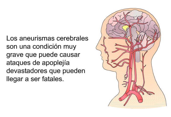 Los aneurismas cerebrales son una condicin muy grave que puede causar ataques de apopleja devastadores que pueden llegar a ser fatales.