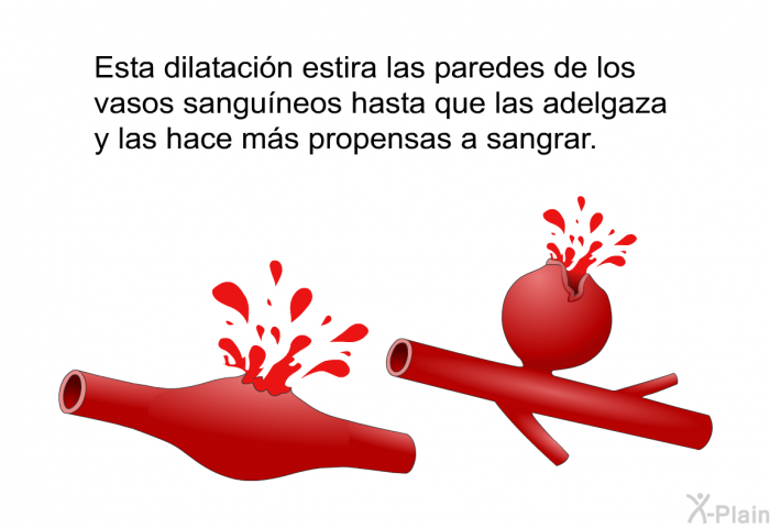 Esta dilatacin estira las paredes de los vasos sanguneos hasta que las adelgaza y las hace ms propensas a sangrar.