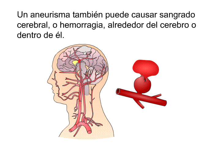 Un aneurisma tambin puede causar sangrado cerebral, o hemorragia, alrededor del cerebro o dentro de l.