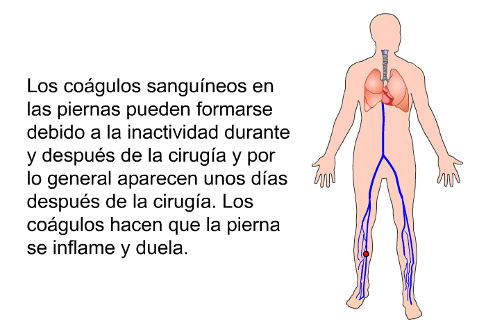 Los cogulos sanguneos en las piernas pueden formarse debido a la inactividad durante y despus de la ciruga y por lo general aparecen unos das despus de la ciruga. Los cogulos hacen que la pierna se inflame y duela.