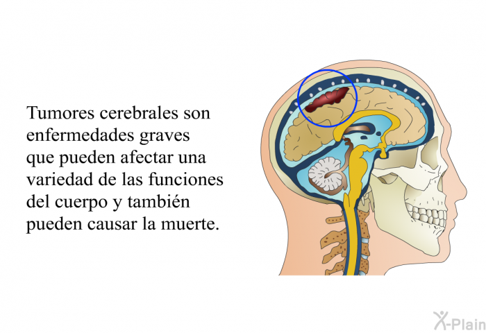 Tumores cerebrales son enfermedades graves que pueden afectar una variedad de las funciones del cuerpo y tambin pueden causar la muerte.