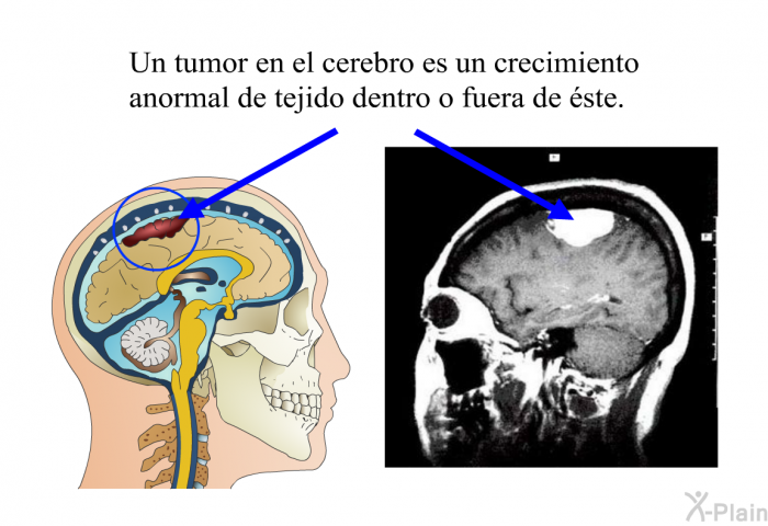 Un tumor en el cerebro es un crecimiento anormal de tejido dentro o fuera de ste.
