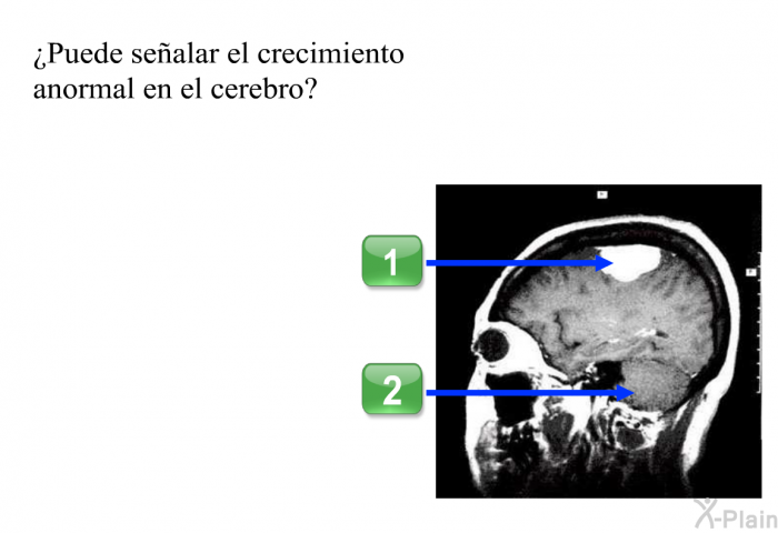 ¿Puede sealar el crecimiento anormal en el cerebro?