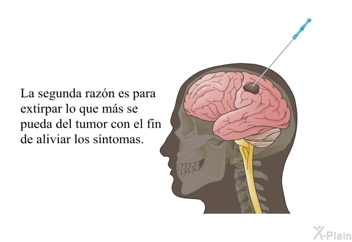La segunda raz�n es para extirpar lo que m�s se pueda del tumor con el fin de aliviar los s�ntomas.