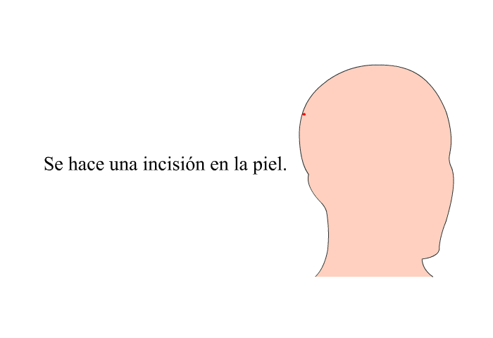 Se hace una incisin en la piel.