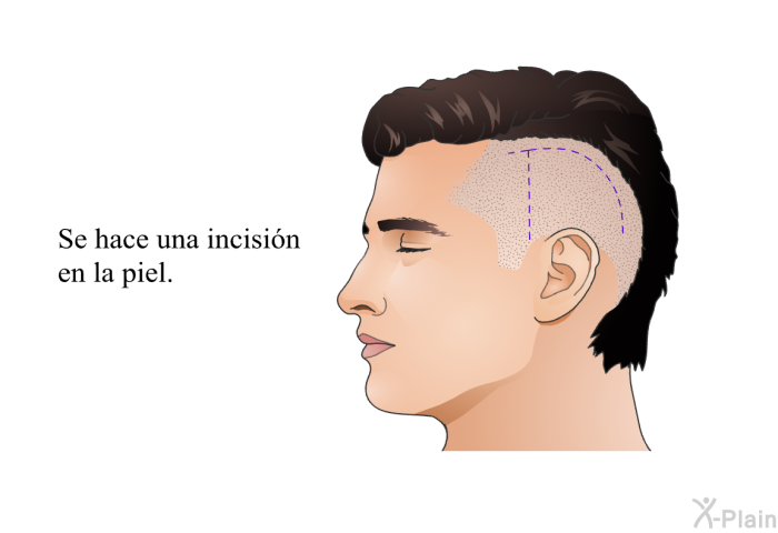 Se hace una incisi�n en la piel.