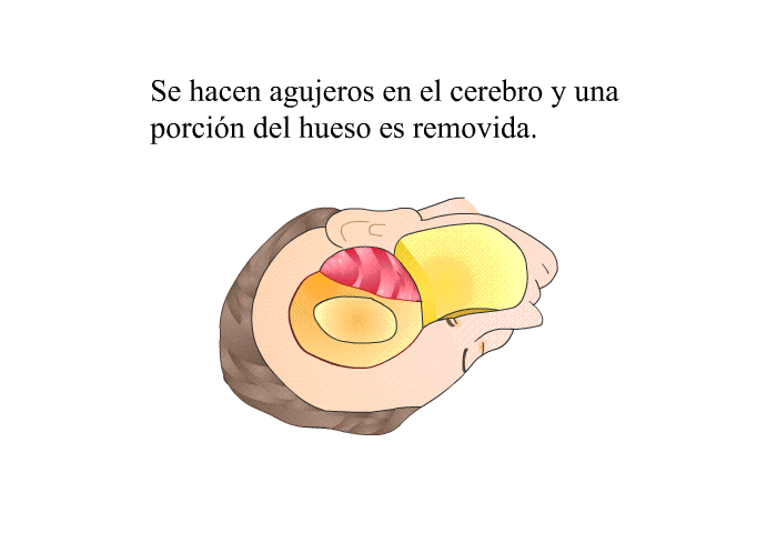 Se hacen agujeros en el cerebro y una porcin del hueso es removida.