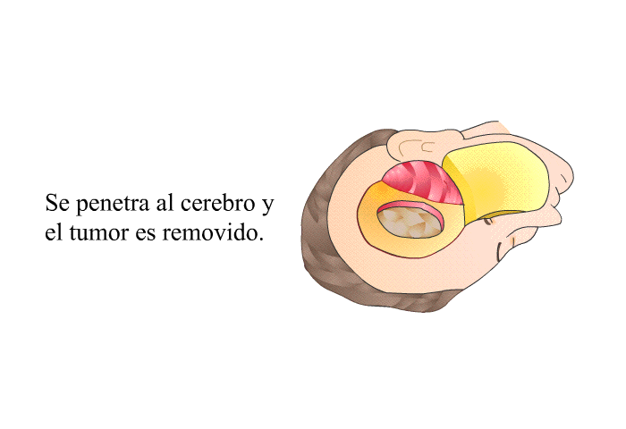Se penetra al cerebro y el tumor es removido.