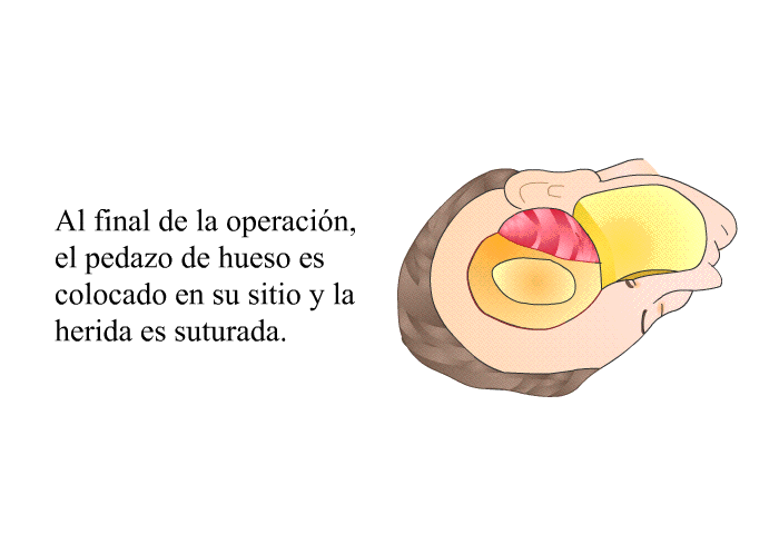 Al final de la operacin, el pedazo de hueso es colocado en su sitio y la herida es suturada.