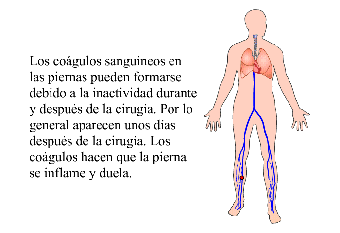 Los cogulos sanguneos en las piernas pueden formarse debido a la inactividad durante y despus de la ciruga. Por lo general aparecen unos das despus de la ciruga. Los cogulos hacen que la pierna se inflame y duela.