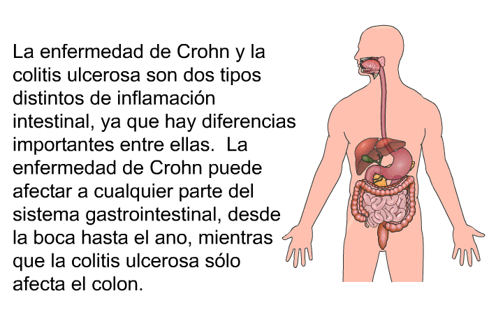 La enfermedad de Crohn y la colitis ulcerosa son dos tipos distintos de inflamacin intestinal, ya que hay diferencias importantes entre ellas. La enfermedad de Crohn puede afectar a cualquier parte del sistema gastrointestinal, desde la boca hasta el ano, mientras que la colitis ulcerosa slo afecta el colon.