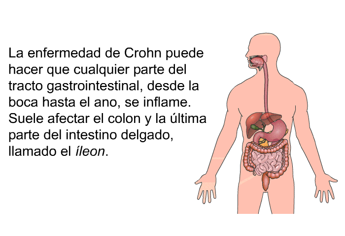 La enfermedad de Crohn puede hacer que cualquier parte del tracto gastrointestinal, desde la boca hasta el ano, se inflame. Suele afectar el colon y la ltima parte del intestino delgado, llamado <I>el leon</I>.