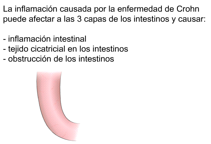 La inflamacin causada por la enfermedad de Crohn puede afectar a las 3 capas de los intestinos y causar:  inflamacin intestinal tejido cicatricial en los intestinos obstruccin de los intestinos