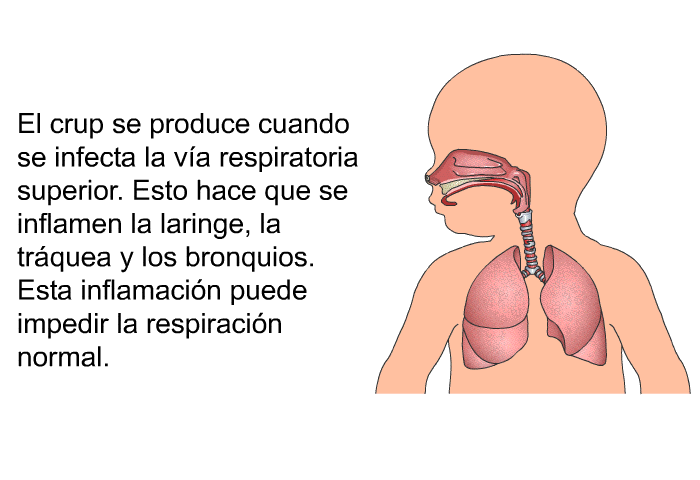 El crup se produce cuando se infecta la va respiratoria superior. Esto hace que se inflamen la laringe, la trquea y los bronquios. Esta inflamacin puede impedir la respiracin normal.