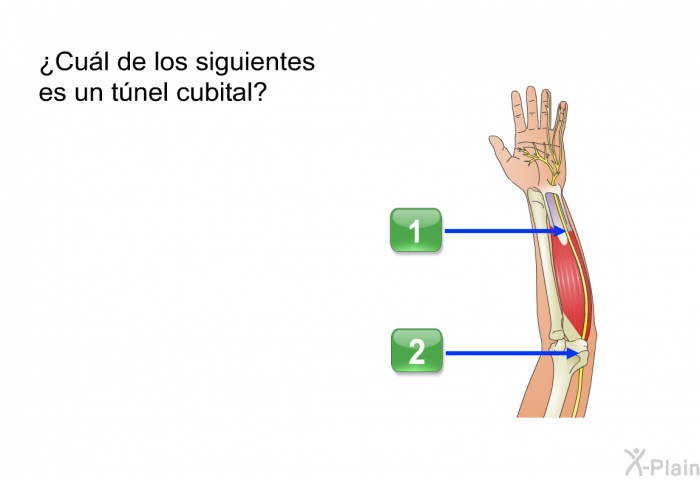 ¿Cul de los siguientes es un tnel cubital? Presione A o B.