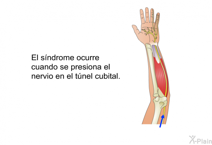 El sndrome ocurre cuando se presiona el nervio en el tnel cubital.