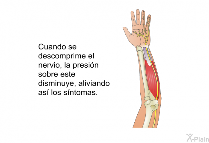 Cuando se descomprime el nervio, la presin sobre este disminuye, aliviando as los sntomas.