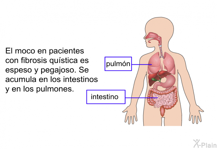 El moco en pacientes con fibrosis qustica es espeso y pegajoso. Se acumula en los intestinos y en los pulmones.